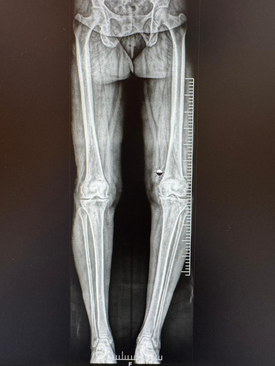 Knee Arthroplasty