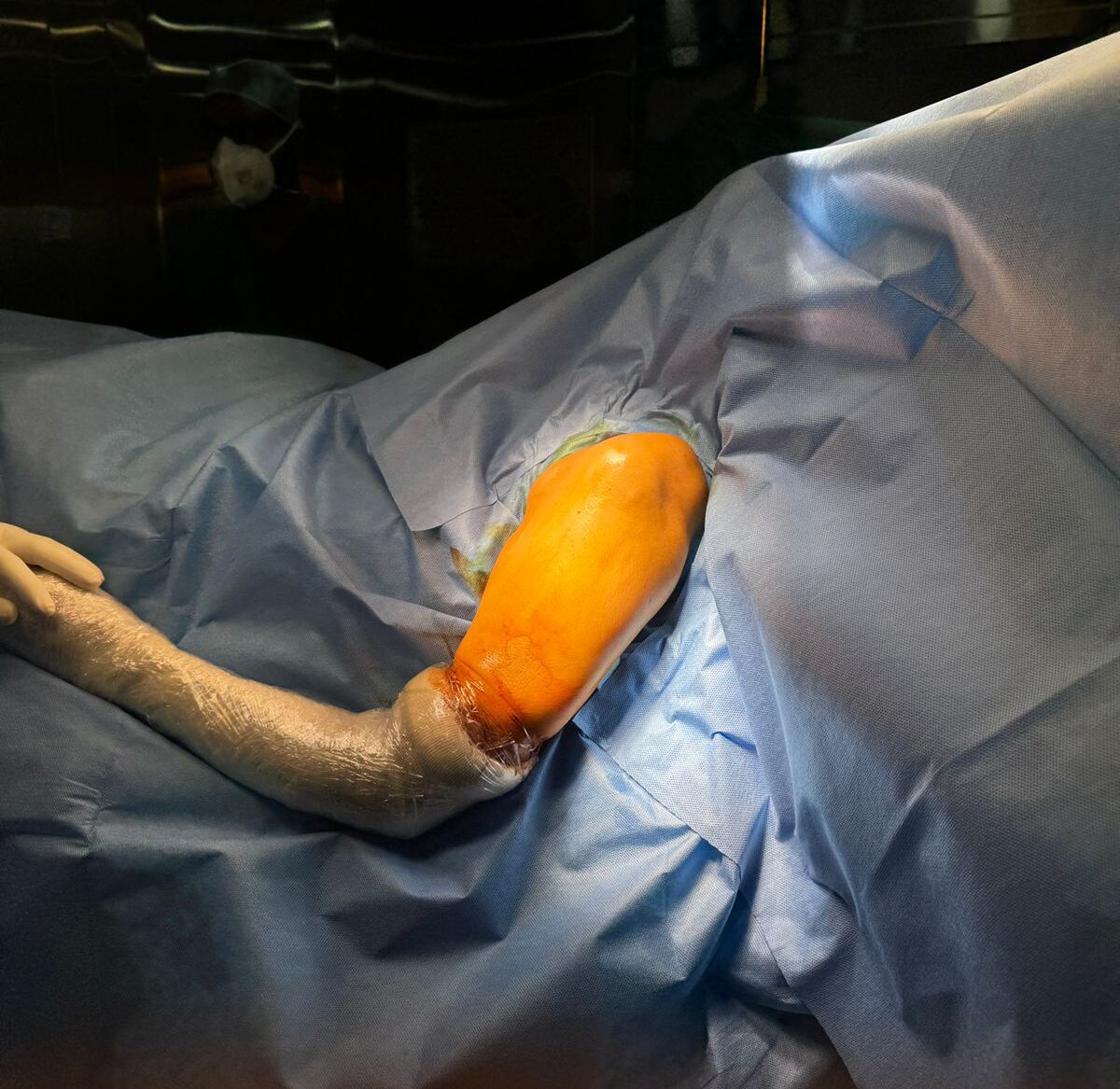 Shoulder Arthroplasty