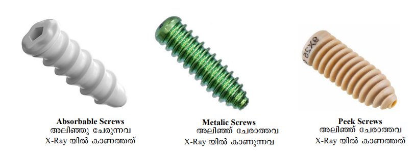 ACL Surgery Implants and Fixation രീതികൾ സമ്പൂർണ്ണ മാർഗ്ഗനിർദ്ദേശം